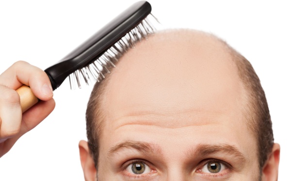 Cấy gen tóc có khả năng điều trị tình trạng hói do di truyền