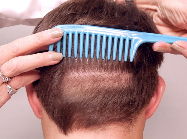Tóc sau cấy mọc dài ra và phát triển như tóc thường