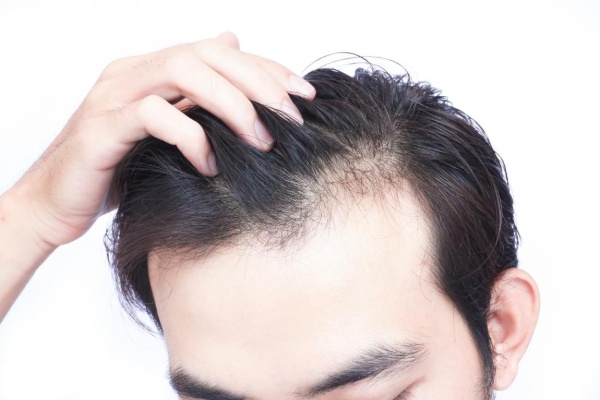 Cấy tóc tự thân không xâm lấn da đầu, phục hồi nhanh