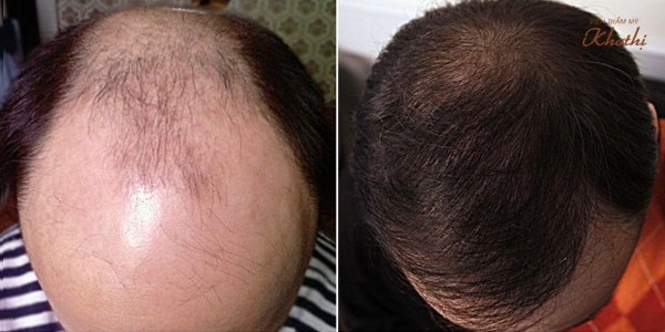 Chi phí cấy tóc tại New Hair sẽ được tính dựa số lượng sợi tóc thay vì số lượng nang tóc