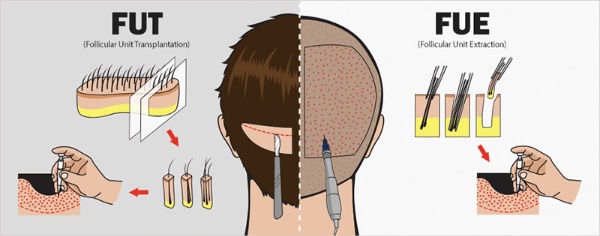 Cấy tóc giá bao nhiêu còn phụ thuộc nhiều vào kỹ thuật mà bạn lựa chọn