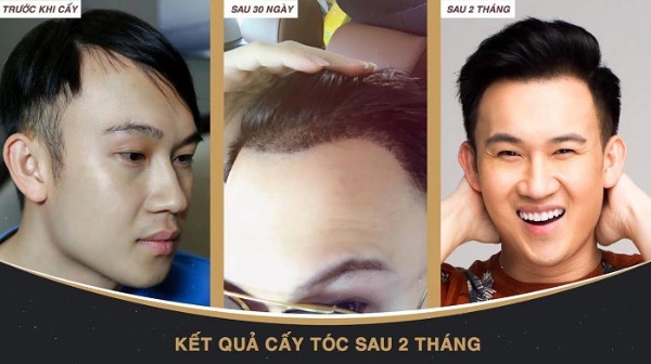 Kết quả mang lại sau 2 -3 tháng từ Dương Triệu Vũ khi lựa chọn cấy tóc tại New Hair Kết quả mang lại sau 2 -3 tháng từ Dương Triệu Vũ khi lựa chọn cấy tóc tại New Hair