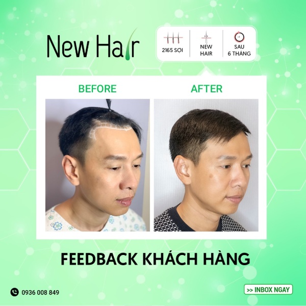 Cấy tóc tự thân sẽ đạt hiệu quả cao nếu bạn lựa chọn địa điểm thực hiện có uy tín