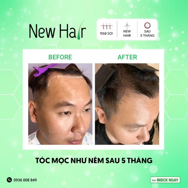 Chỉ 5 tháng sau khi cấy, tóc ở vùng da đầu bị hói đã mọc dày và dài hơn