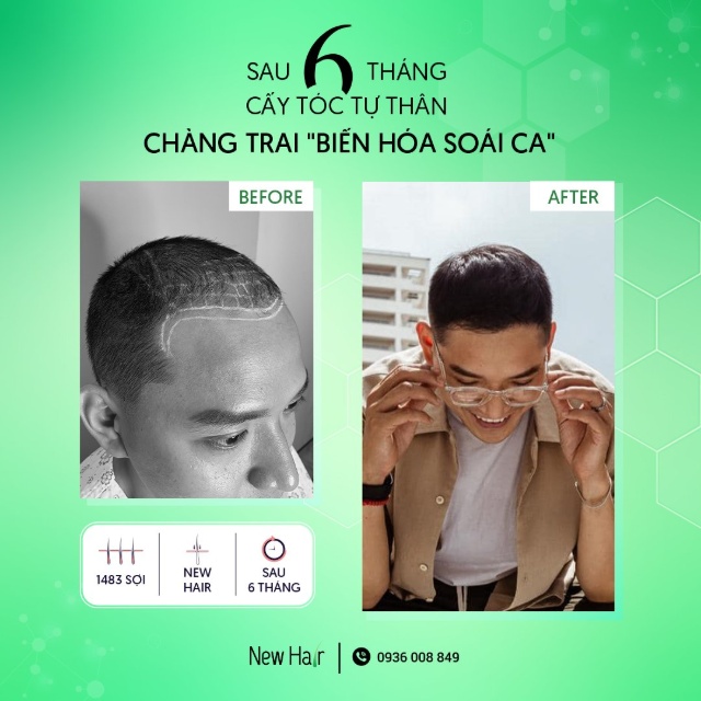 Cấy tóc tự thân là gì