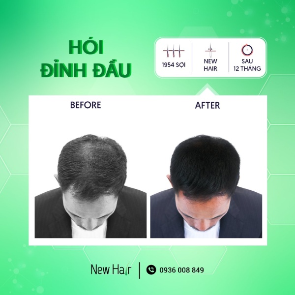 Cấy tóc tự thân có thể khắc phục được mọi tình trạng hói ở đầu
