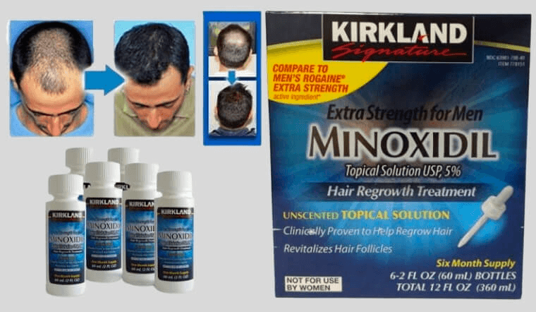thuốc Minoxidil hỗ trợ điều trị rụng tóc hói đầu