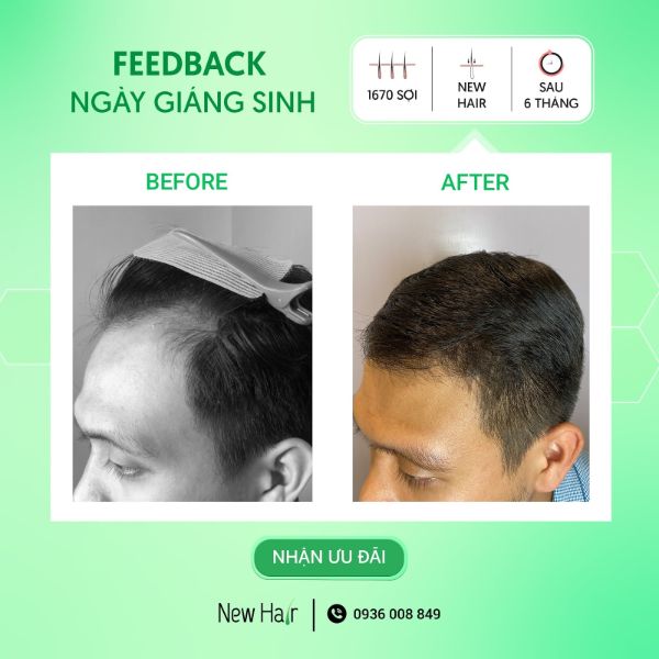 Sự thay đổi rõ rệt trên mái tóc của khách hàng sau khi cấy tóc tại New Hair