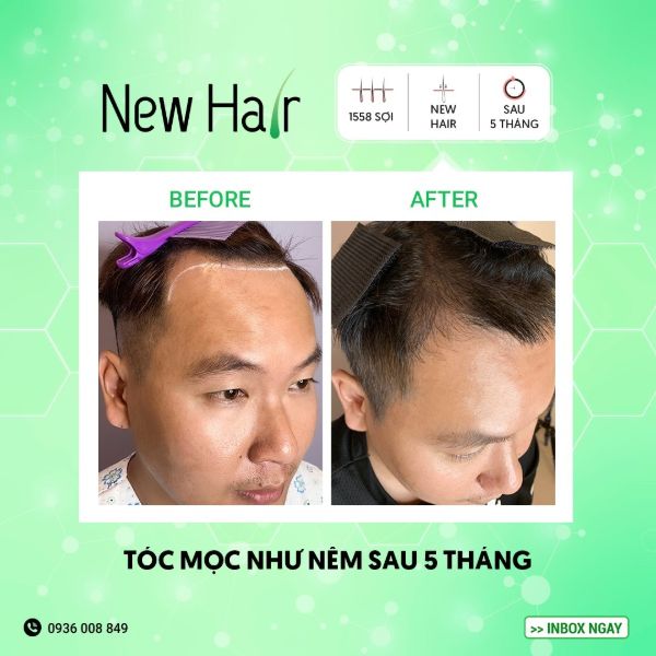 Kỹ thuật cấy tóc tự thân tại New Hair có thể giải quyết mọi tình trạng hói đầu