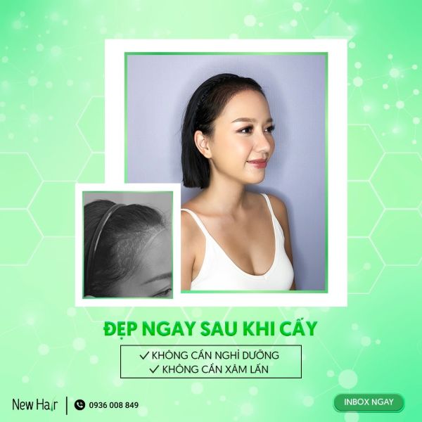 Diện mạo thay đổi nhờ cấy tóc tự thân