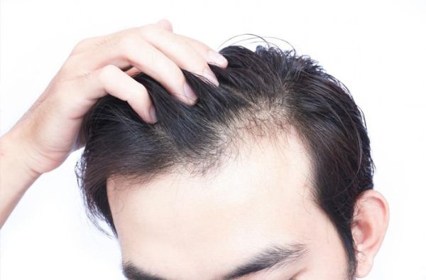 Tóc rụng nhiều và liên tục trong thời gian dài là biểu hiện của hói tóc