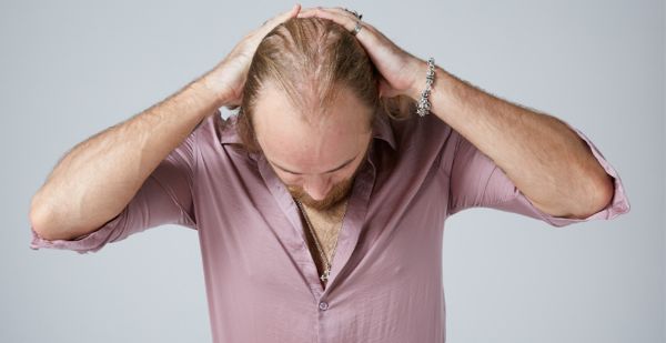 Tóc rụng nhiều 2 bên trán và lan dần xuống gáy