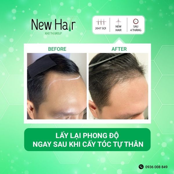 Cấy tóc tự thân FUE giúp nam giới lấy lại phong độ chỉ sau 1 lần thực hiện