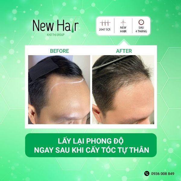 Kết quả mang đến sau quá trình cấy tóc tự thân. Kết quả mang đến sau quá trình cấy tóc tự thân