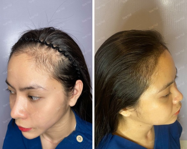 Hình ảnh trước và sau khi cấy tóc tự thân FUE tại New Hair