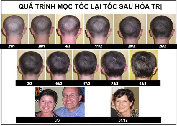 Quá trình mọc lại tóc sau hóa trị của một bệnh nhân nữ
