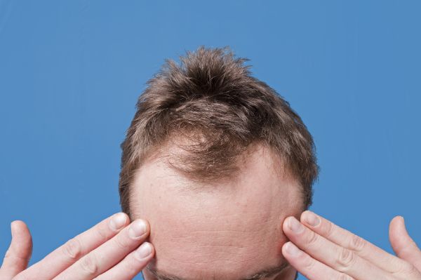 Tình trạng tóc rụng nhiều bất thường ở một vị trí nhất định