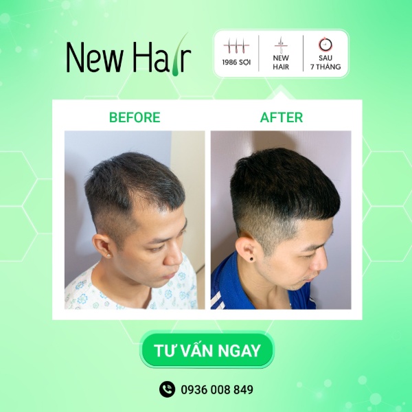 Khách hàng cấy tóc tự thân tại New Hair