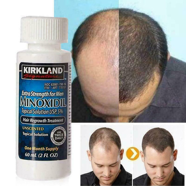 Minoxidil (Rogaine) - Một loại thuốc bôi ngoài da phổ biến trong trị hói đầu