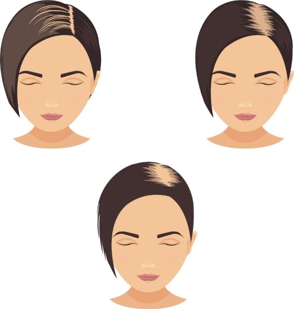 Cấy tóc tự thân cấy có nhiều ưu điểm