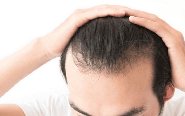 Hói đầu chữ M thường xảy ra ở nam giới