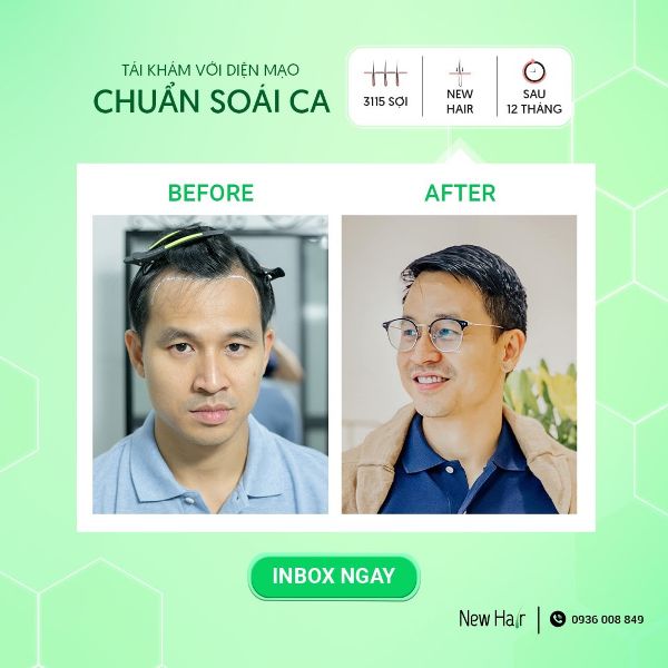 Cấy tóc tự thân tại New Hair