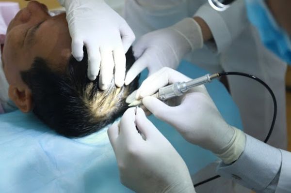 Tiến trình cấy tóc sau khi xác định được nguyên nhân tiến trình việc cấy tóc