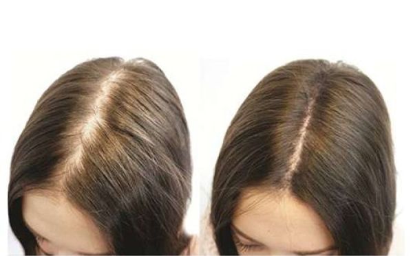 Tóc mọc dày đẹp sau một thời gian sử dụng dầu dừa Tóc mọc dày đẹp sau một thời gian sử dụng dầu dừa
