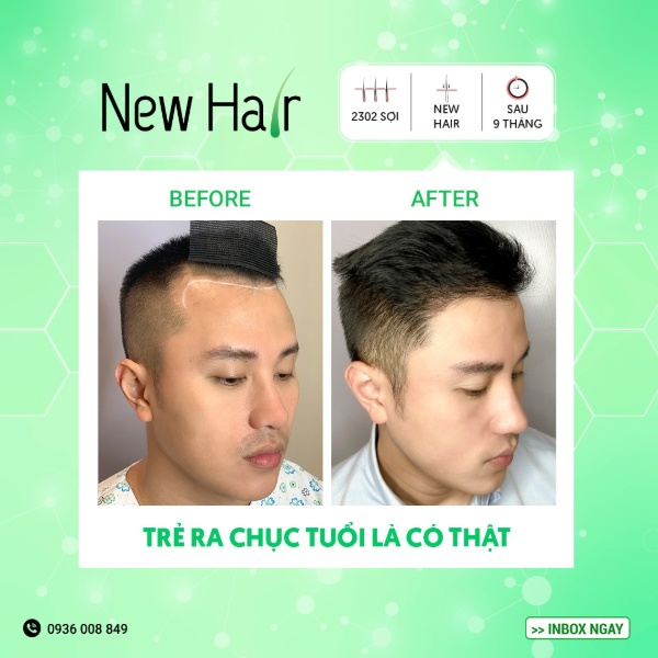Cấy tóc tự thân mang đến trải nghiệm hoàn toàn khác cho khách hàng