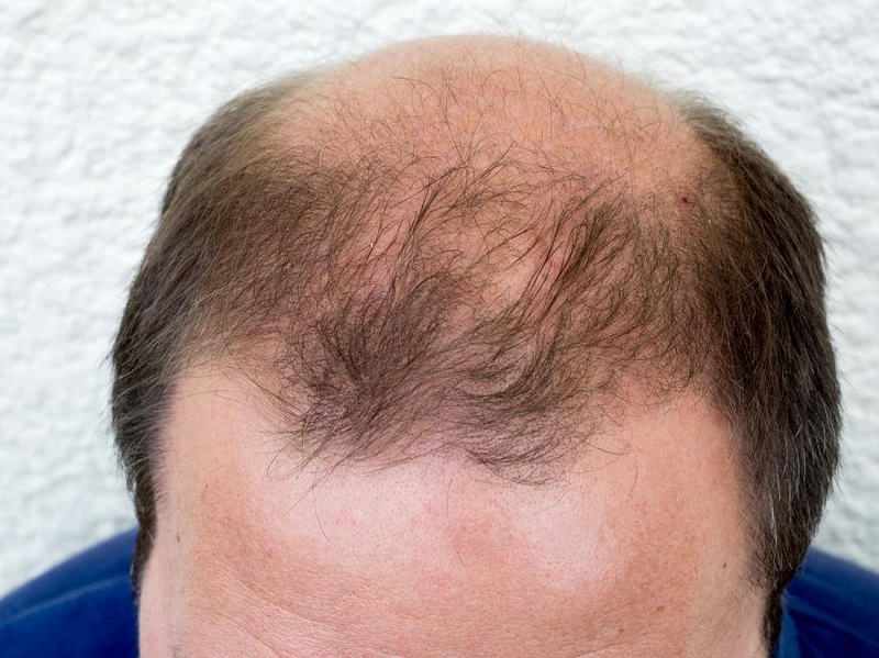Hói đầu là tình trạng trán hoặc đỉnh đầu thưa tóc