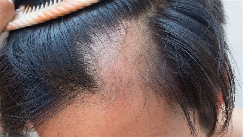 đầu bị hói từng mảng lớn