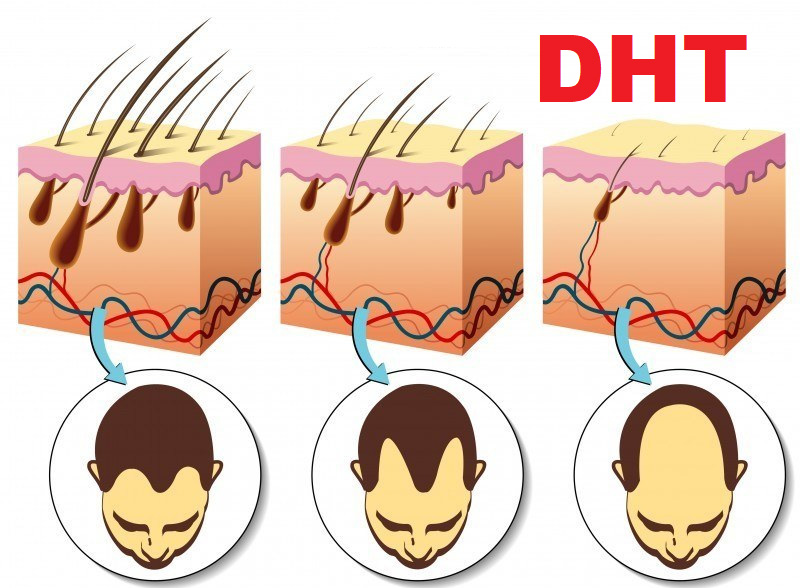Tác động của hormone DHT gây teo nang tóc và hói đầu ở nam giới