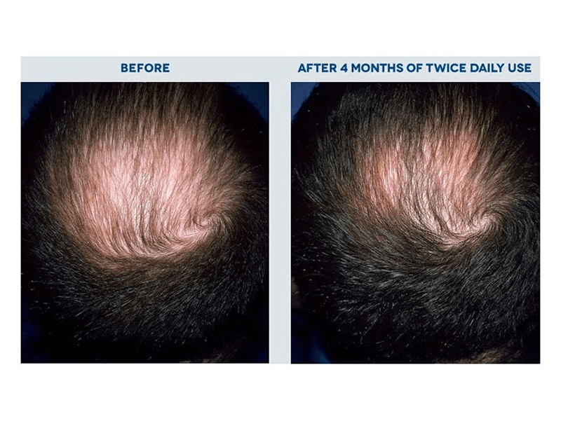 trước và sau khi điều trị hói đầu bằng minoxidil