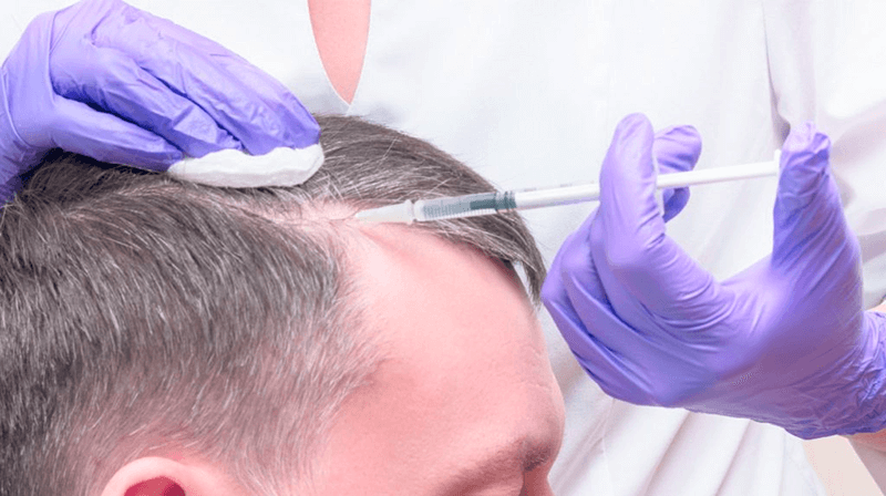 tiêm corticosteroid vào vùng da đầu bị hói