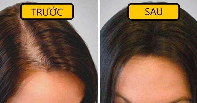 hình ảnh trước và sau khi trị hói đầu bằng thuốc của 1 cô gái