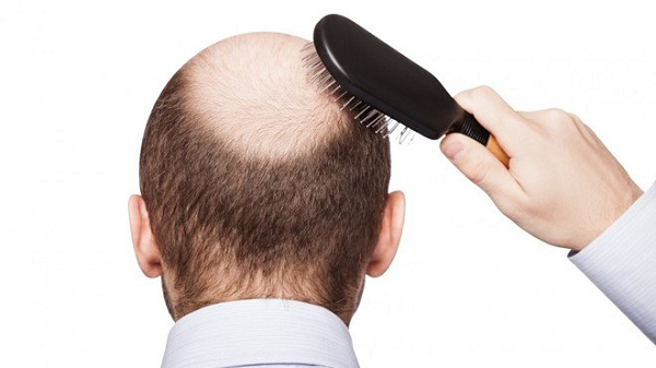 Hói đầu gây mất thẩm mỹ