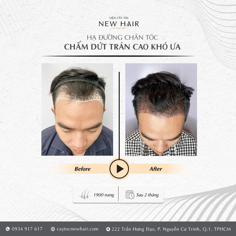 trước và sau khi cấy tóc tự thân