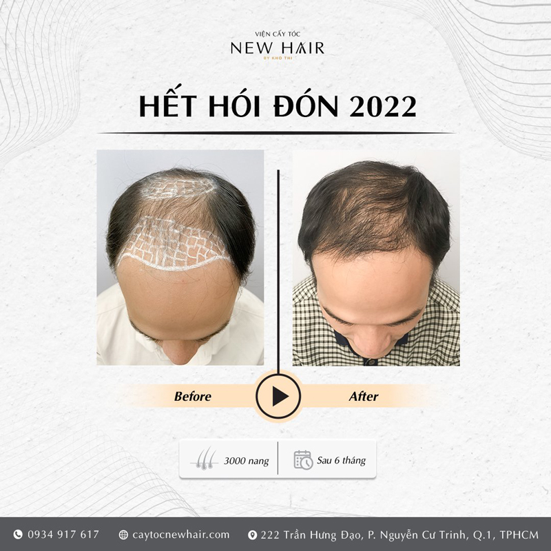 Kết quả cấy tóc giữa đỉnh đầu