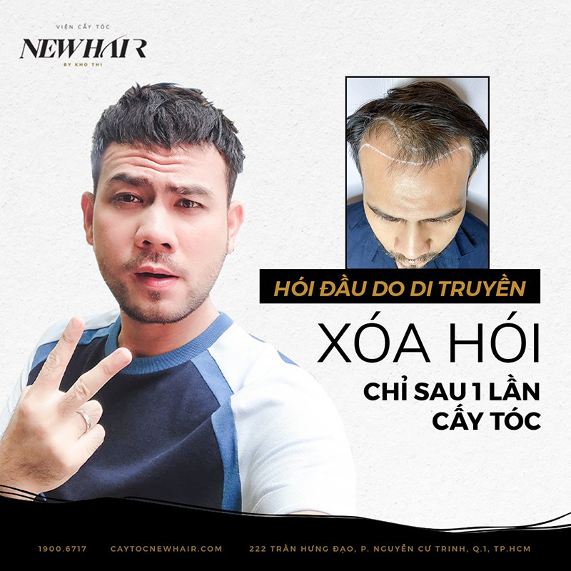 Cấy tóc là giải pháp trị hói triệt