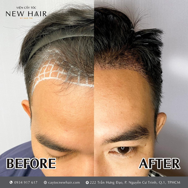 Cấy tóc mang đến vẻ đẹp tự nhiên