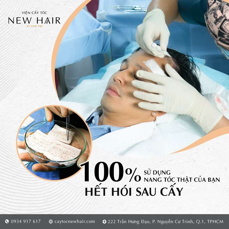 Cấy tóc tại New Hair