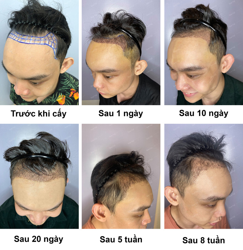 Quá trình mọc lại tóc sau khi cấy của bệnh nhân nam hói trước trán nặng