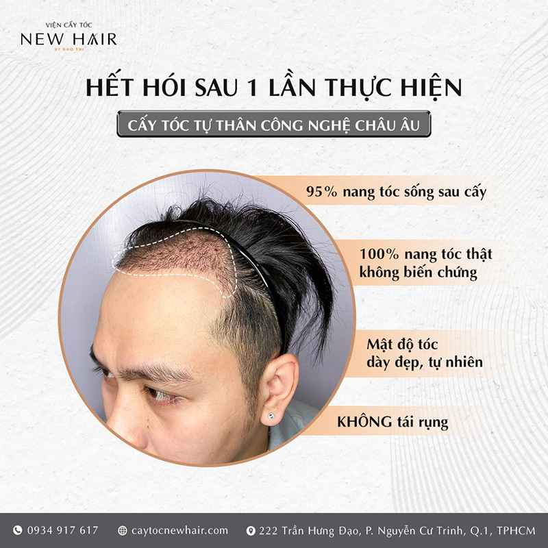 Hiệu quả mọc tóc đến 95%