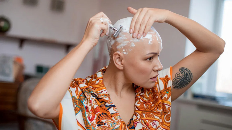 Hói đầu có di truyền không