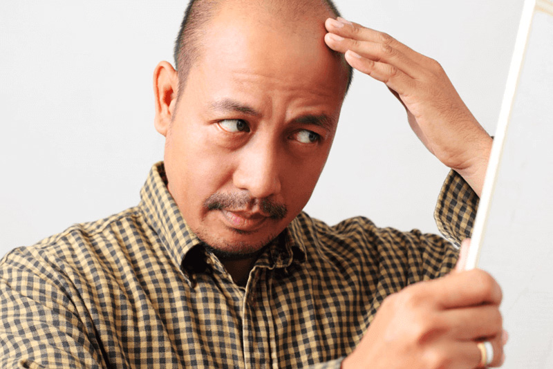 Hói đầu di truyền có chữa được không?