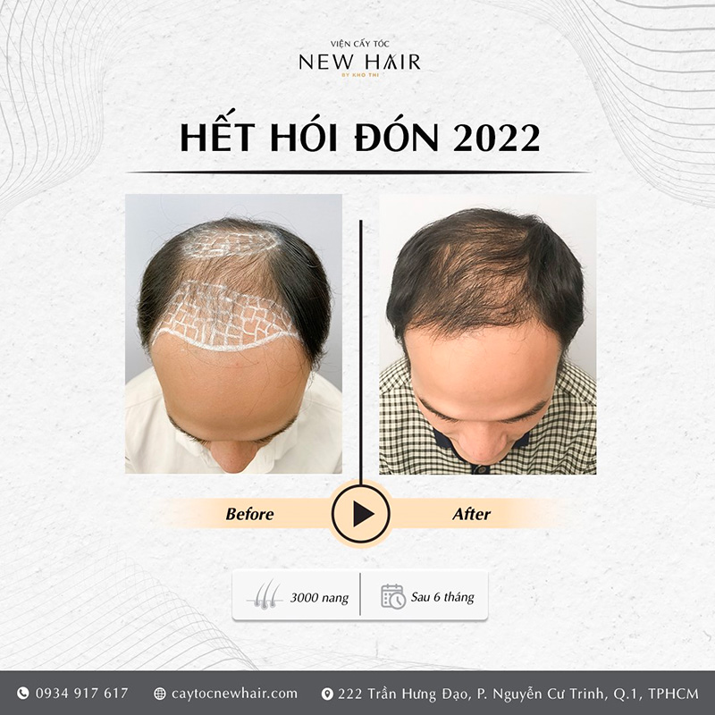Khách hàng sau 6 tháng điều trị bằng phương pháp cấy tóc