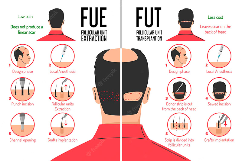 So sánh kỹ thuật cấy tóc FUT VÀ FUE
