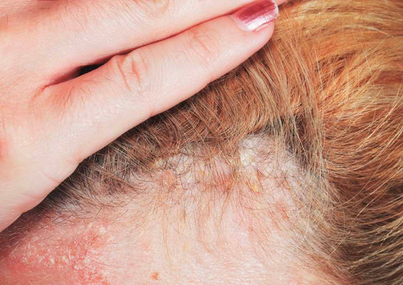 Nhiều trường hợp tóc rụng kèm với mẩn đỏ, ngứa rát là dấu hiệu nghiêm trọng
