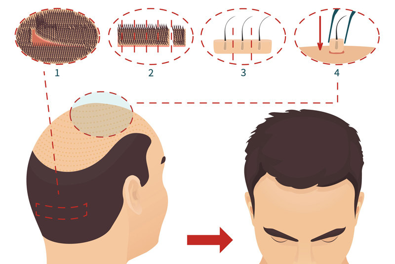 Quy trình cấy tóc tự thân theo phương pháp FUT
