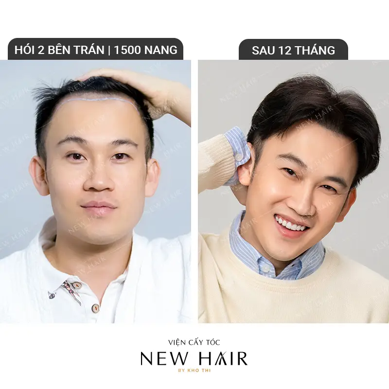 hình ảnh trước và sau khi cấy tóc tại new hair